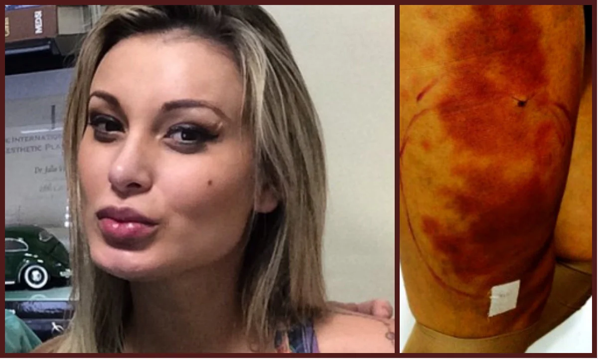 urach