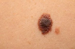 Melanoma. Foto: Divulgação/SBCO