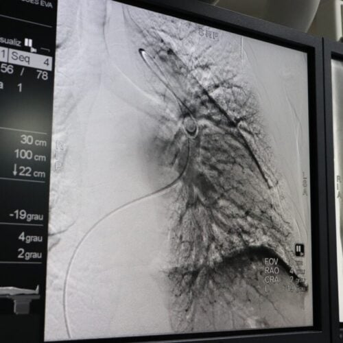 Médicos do HGG recebem capacitação para realizar angioplastia pulmonar por balão. Foto: SES-GO