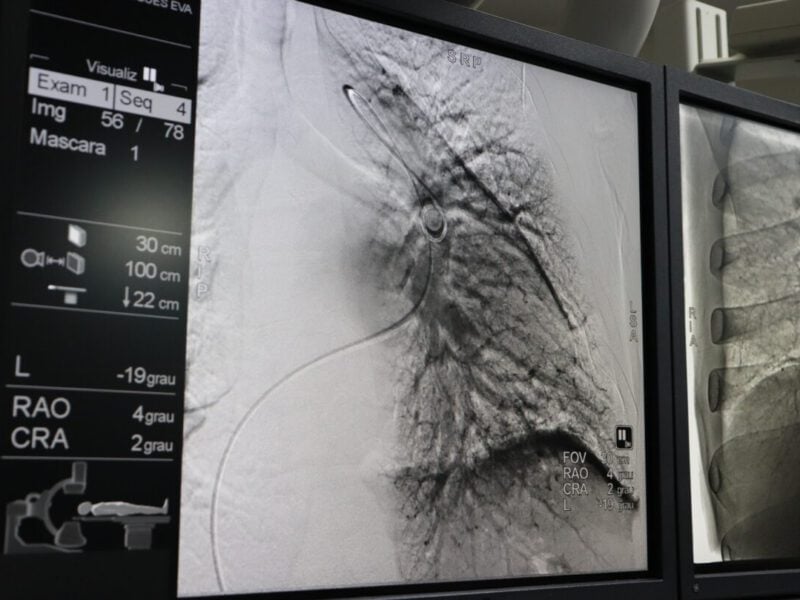 Médicos do HGG recebem capacitação para realizar angioplastia pulmonar por balão. Foto: SES-GO