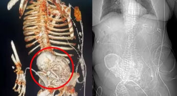 Idosa que descobriu feto calcificado, carregado por mais de 50 anos, morre após cirurgia