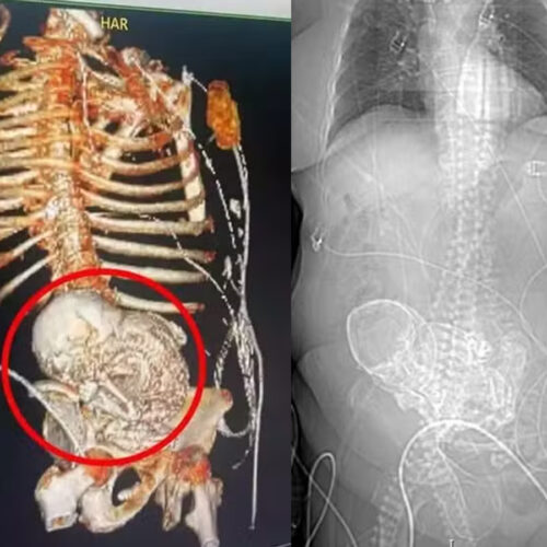 Litopedia feto calcificado gravidez idosa