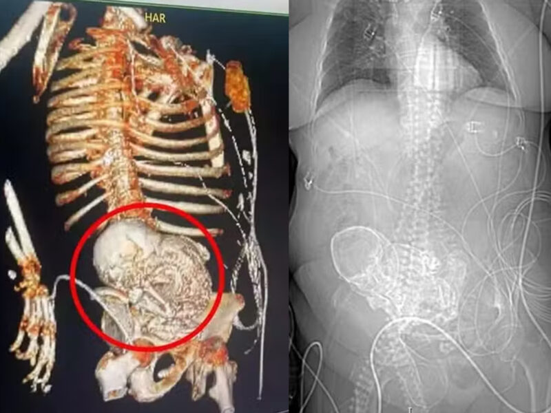 Litopedia feto calcificado gravidez idosa